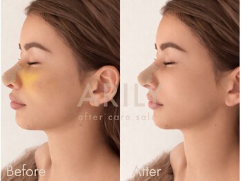 アリリィ(ARILY)/ダウンタイムケア/表参道/外苑前