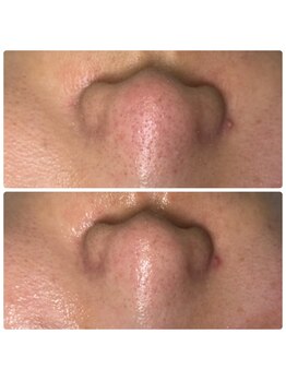 サラン スキンサロン(Sarang skin salon)の写真/【黒ずみ・いちご鼻卒業】プロの毛穴洗浄で頑固な汚れをすっきりオフ！触りたくなるツルツル素肌へ♪
