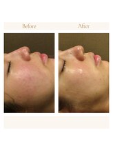 インプレス ラミール/～1ヶ月での変化