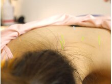 本厚木 リターナル(ReTurnal)/鍼/首肩こり