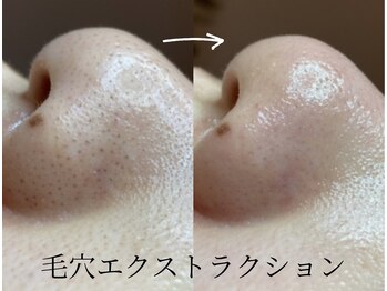 マシェリ(ma cherie)/毛穴エクストラクションコース