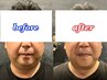 【根本から脂肪撃退】大人気レモンボトル(頬、顎下)