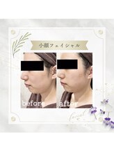 アディッシモ(addissimo)/マシーン＋マッサージで速攻小顔