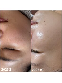 リノ(lino)/イヤなシミ改善するならこれ！