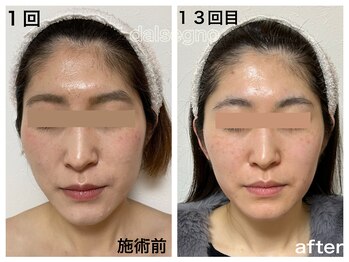 ダルセーニョ/縦ラインを短く整えるコルギ技術