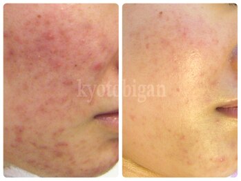京都美顔/赤みや跡が気になるニキビケア