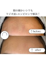 ユヌランコント 岐阜店(Une rencontre)/エンビロン×ラジオ波