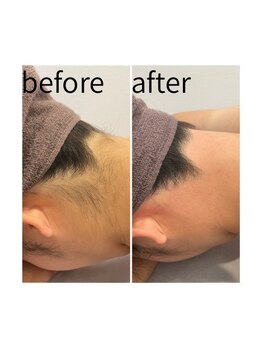 脱毛サロンnamir札幌店【ブラジリアンワックス/美容脱毛/眉毛】～メンズ/レディース～/lady【うなじワックス】