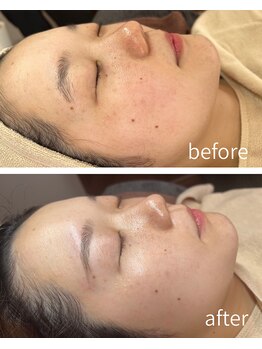 依-より- 【糸脱毛/顔脱毛/スレッディング/眉毛/まゆげ/アイブロウ/ヘッドスパ】の写真/≪糸脱毛◆スレッディングで顔脱毛≫角質/産毛を絡めとり、脱毛のみでは得られない内側から弾けるつや感◎