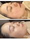 依-より- 【糸脱毛/顔脱毛/スレッディング/眉毛/まゆげ/アイブロウ/ヘッドスパ】の写真/≪糸脱毛◆スレッディングで顔脱毛≫角質/産毛を絡めとり、脱毛のみでは得られない内側から弾けるつや感◎