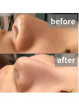 ドクターエイチ 麻布十番店(Doctor.H)/ハイドロピーリング