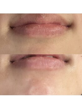 リアアイズ(Li'a eyes)/フェイスワックス顎＋口下