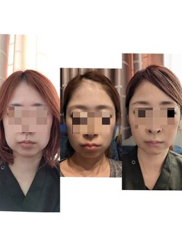 トリニティスペース(TrinitySpace)/レモンボトルビフォーアフター