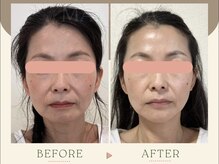 40代・施術3回フェイスラインupスッキリ若見え顔！京都小顔矯正