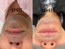 ふぁみーゆ(famille)/ヒゲ脱毛で清潔感アップ☆