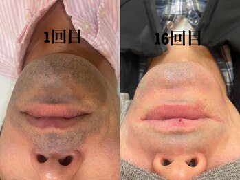 ふぁみーゆ(famille)/ヒゲ脱毛で清潔感アップ☆