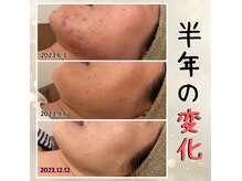 プルーム 大橋店(plume)の雰囲気（【ニキビケア】半年の変化/30代女性/ハーブピーリング）