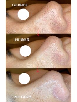 アルティ 福岡大名店(ARTI,)/毛穴洗浄