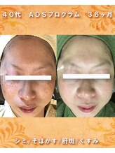 ナイア(naia)/リセラADS使用症例