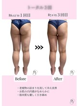 プラスワンビューティテン 新大阪店(Plus One Beauty)/ボディ/ハイパーナイフ/痩身