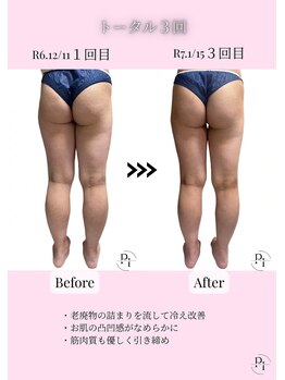 プラスワンビューティテン 新大阪店(Plus One Beauty)/ボディ/ハイパーナイフ/痩身