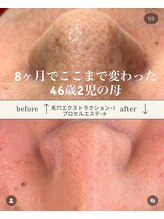 七や美肌/開き毛穴、黒ずみ、凸凹いちご鼻