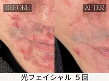 スキンジム(SKIN GYM)/繰り返す大人ニキビも改善可能