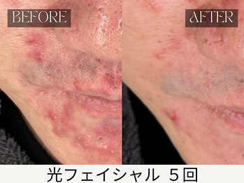 スキンジム(SKIN GYM)/繰り返す大人ニキビも改善可能