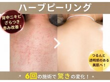 ウィズサロン 天神店(withサロン)の雰囲気（背中の色沈・ニキビケアはハーブピーリング）