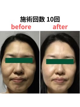 縁 整体院 和歌山院(en)/ハーブピーリング