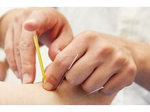 オーブ たかまつはり灸整骨院くじら館(aube)/くじら館》鍼灸