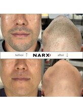 ナークス(NARX)/【ヒゲ脱毛】ビフォーアフター