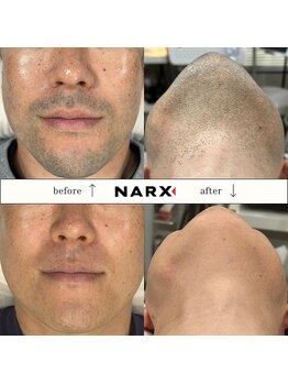 ナークス(NARX)/【ヒゲ脱毛】ビフォーアフター