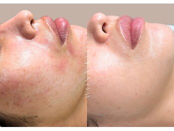 ウォナ(WONA)/【お客様症例】