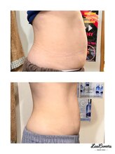 ヒーリングリゾート ナゴミ(Nagomi)/脂肪冷却ビフォアフ