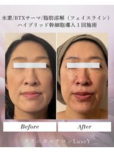 リュクシー(LuxeY)/輪郭形成小顔たるみケア