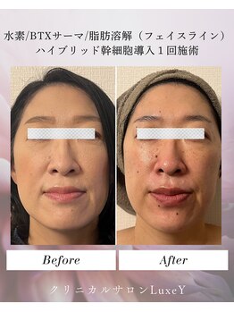 リュクシー(LuxeY)/輪郭形成小顔たるみケア