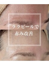 サロン ド ベル(Salon de Belle)/赤ら肌にもララピール！