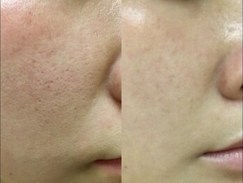 リノ(Lino)の写真/＼30代からの黒ずみ・開き毛穴／大人気【剥けないハーブピーリング】で本気の肌質改善◎ダウンタイムなし！