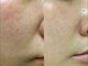 リノ(Lino)の写真/＼30代からの黒ずみ・開き毛穴／大人気【剥けないハーブピーリング】で本気の肌質改善◎ダウンタイムなし！
