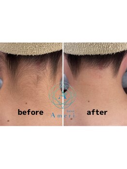 サロンアメリ イオンモール綾川店(Salon Ameri)/香川　うなじ脱毛　職人アメリ