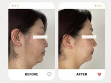 スキンケアサロンプリューム(skin care saron plume)の雰囲気（施術７回（40代）フェイスラインがすっきりされ肌のくすみも改善）