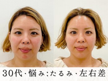 ジョンミー(JONMEE)/小顔矯正で叶う、小顔たるみ改善