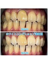 ホワイトニングショップ 津田沼店/before&after美白ホワイトニング