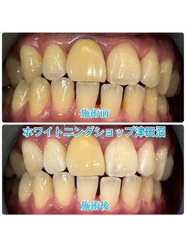 ホワイトニングショップ 津田沼店/before&after美白ホワイトニング