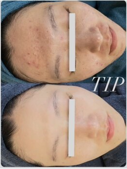 ヒメミ(Himemi)/TIPハーブピーリング