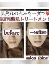 サロンシャイン(Salon Shine)/REVI１回２０代女性