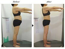 ビューティークリニックコダマ 日向店/【1か月コース】F.N様（45歳）