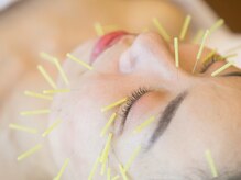 もり鍼灸整骨院 今出川マッサージ治療院/美容鍼/小顔矯正