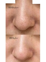 リコア(Likoa)/初回のbefore afterです